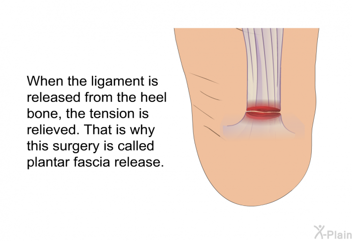 When the ligament is released from the heel bone, the tension is relieved. That is why this surgery is called plantar fascia release.