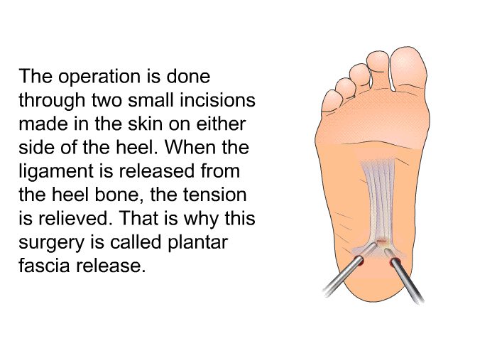 The operation is done through two small incisions made in the skin on either side of the heel. When the ligament is released from the heel bone, the tension is relieved. That is why this surgery is called plantar fascia release.