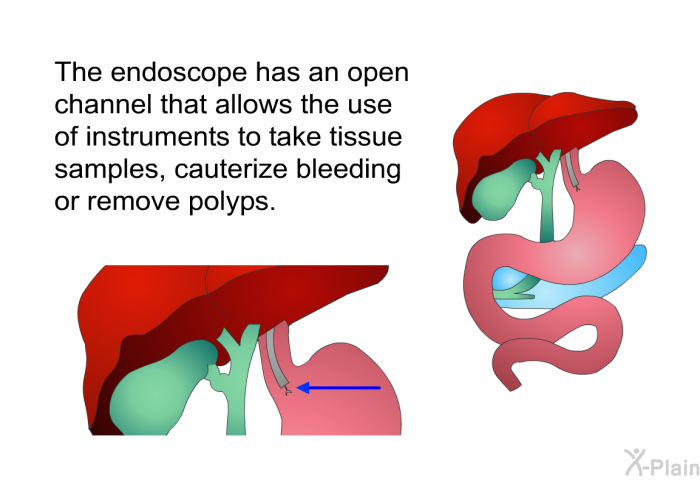 The endoscope has an open channel that allows the use of instruments to take tissue samples, cauterize bleeding or remove polyps.