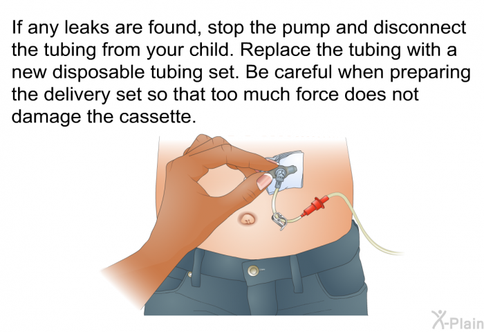 If any leaks are found, stop the pump and disconnect the tubing from your child. Replace the tubing with a new disposable tubing set. Be careful when preparing the delivery set so that too much force does not damage the cassette.
