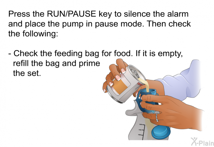 Press the RUN/PAUSE key to silence the alarm and place the pump in pause mode. Then check the following:  Check the feeding bag for food. If it is empty, refill the bag and prime the set.