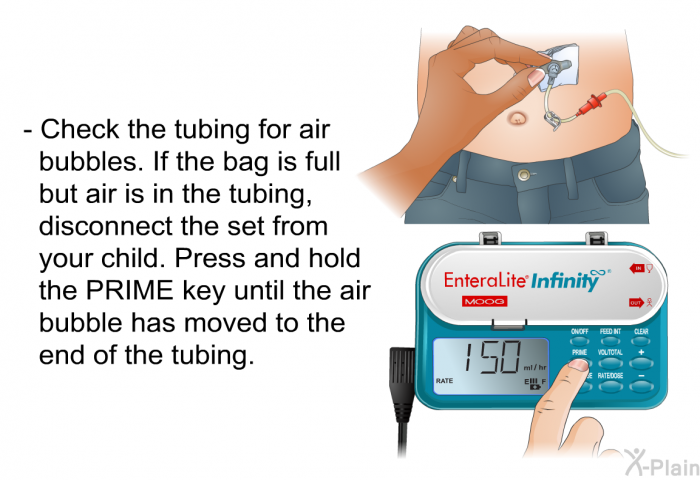 Check the tubing for air bubbles. If the bag is full but air is in the tubing, disconnect the set from your child. Press and hold the PRIME key until the air bubble has moved to the end of the tubing.