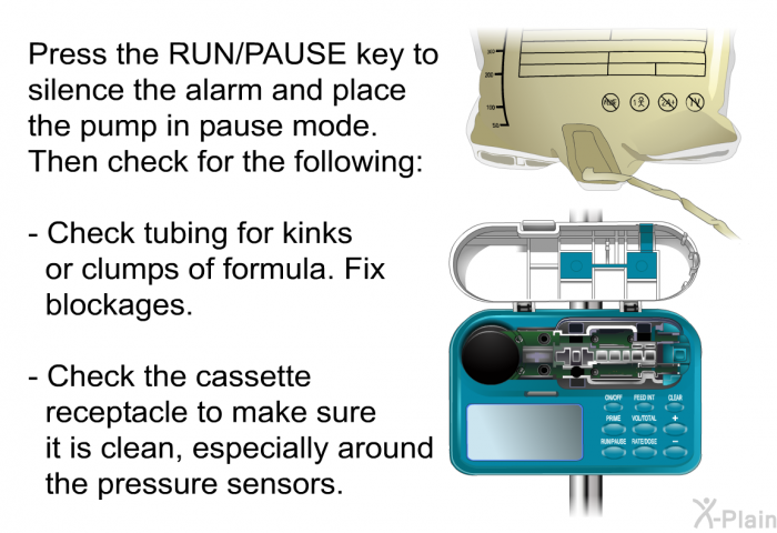 Press the RUN/PAUSE key to silence the alarm and place the pump in pause mode. Then check for the following:  Check tubing for kinks or clumps of formula. Fix blockages. Check the cassette receptacle to make sure it is clean, especially around the pressure sensors.