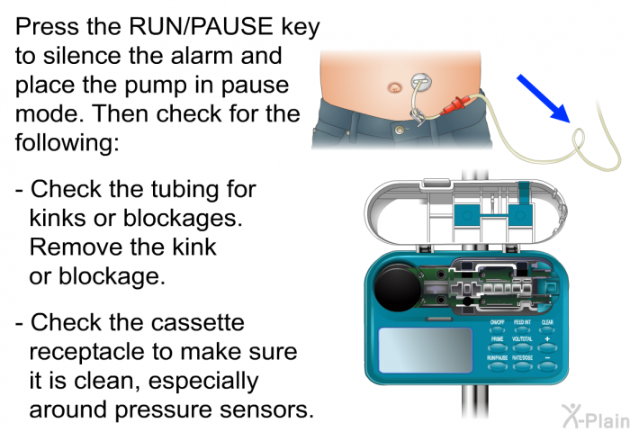 Press the RUN/PAUSE key to silence the alarm and place the pump in pause mode. Then check for the following:  Check the tubing for kinks or blockages. Remove the kink or blockage. Check the cassette receptacle to make sure it is clean, especially around pressure sensors.