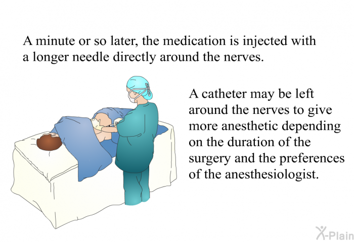 A minute or so later, the medication is injected with a longer needle directly around the nerves. A catheter may be left around the nerves to give more anesthetic depending on the duration of the surgery and the preferences of the anesthesiologist.