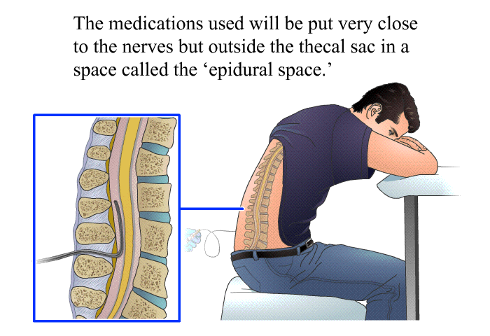 The medications used will be put very close to the nerves but outside the thecal sac in a space called the  epidural space.'