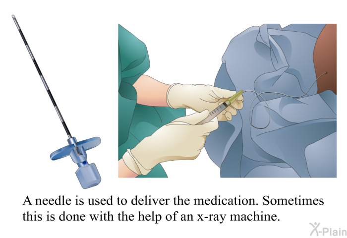 A needle is used to deliver the medication. Sometimes this is done with the help of an x-ray machine.