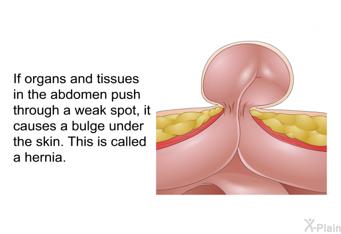 If organs and tissues in the abdomen push through a weak spot, it causes a bulge under the skin. This is called a hernia.