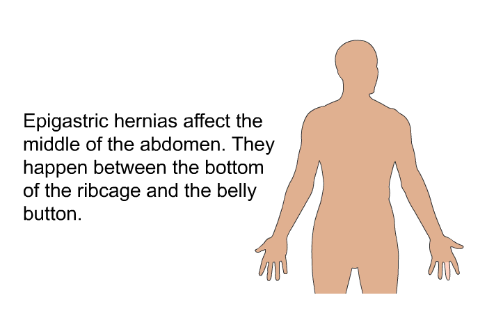 Epigastric hernias affect the middle of the abdomen. They happen between the bottom of the ribcage and the belly button.
