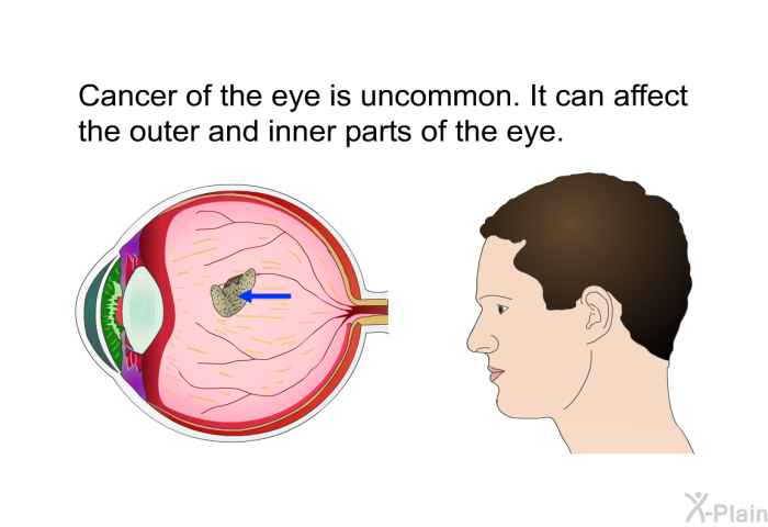 Cancer of the eye is uncommon. It can affect the outer and inner parts of the eye.