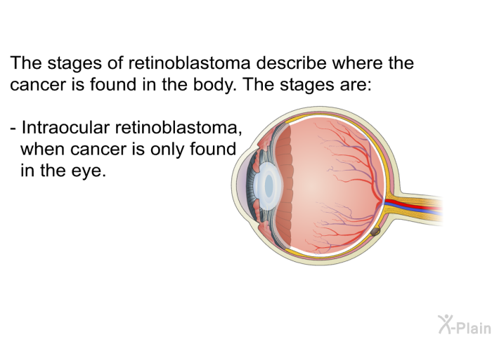 The stages of retinoblastoma describe where the cancer is found in the body. The stages are:  Intraocular retinoblastoma, when cancer is only found in the eye.