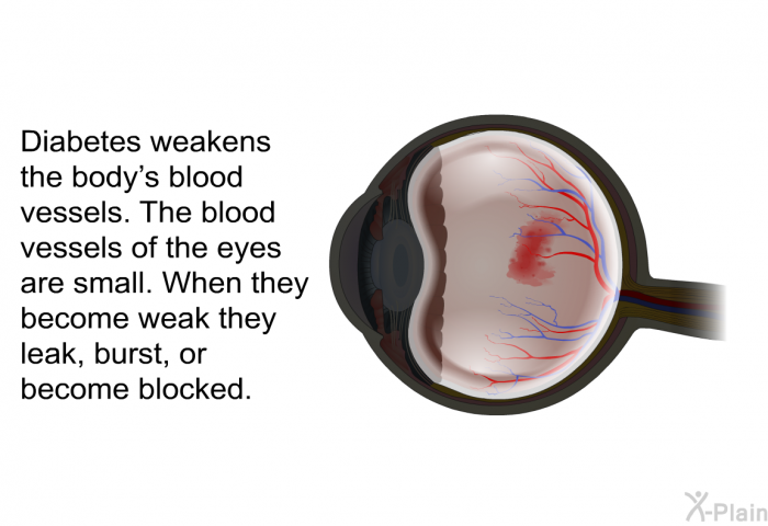 Diabetes weakens the body's blood vessels. The blood vessels of the eyes are small. When they become weak they leak, burst, or become blocked.