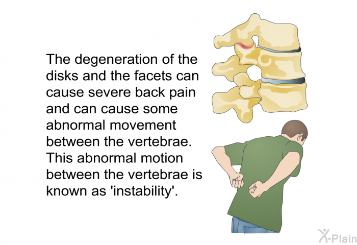 The degeneration of the disks and the facets can cause severe back pain and can cause some abnormal movement between the vertebrae. This abnormal motion between the vertebrae is known as  instability'.