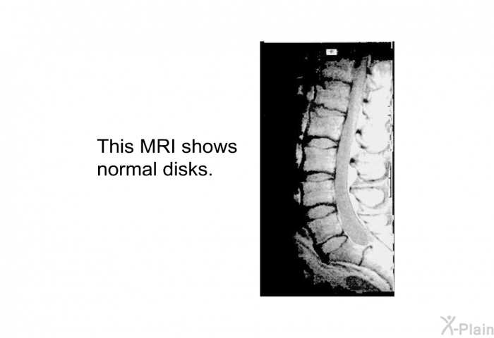 This MRI shows normal disks.