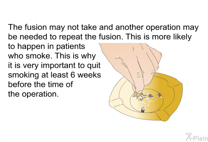 The fusion may not take and another operation may be needed to repeat the fusion. This is more likely to happen in patients who smoke. This is why it is very important to quit smoking at least 6 weeks before the time of the operation.