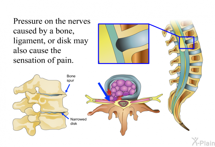 Pressure on the nerves caused by a bone, ligament, or disk may cause the sensation of pain.