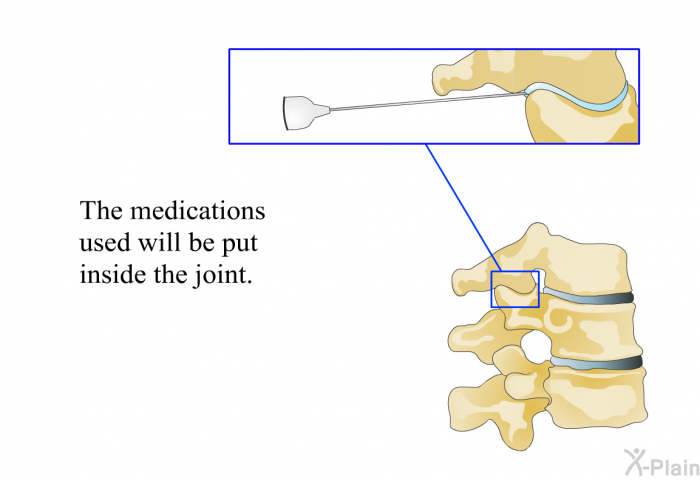 The medications used will be put inside the joint.