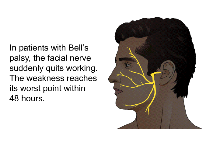In patients with Bell's palsy, the facial nerve suddenly quits working. The weakness reaches its worst point within 48 hours.