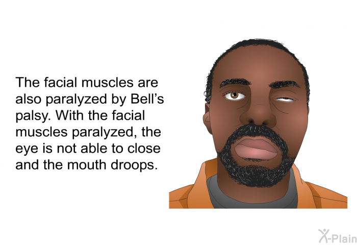 The facial muscles are also paralyzed by Bell's palsy. With the facial muscles paralyzed, the eye is not able to close and the mouth droops.