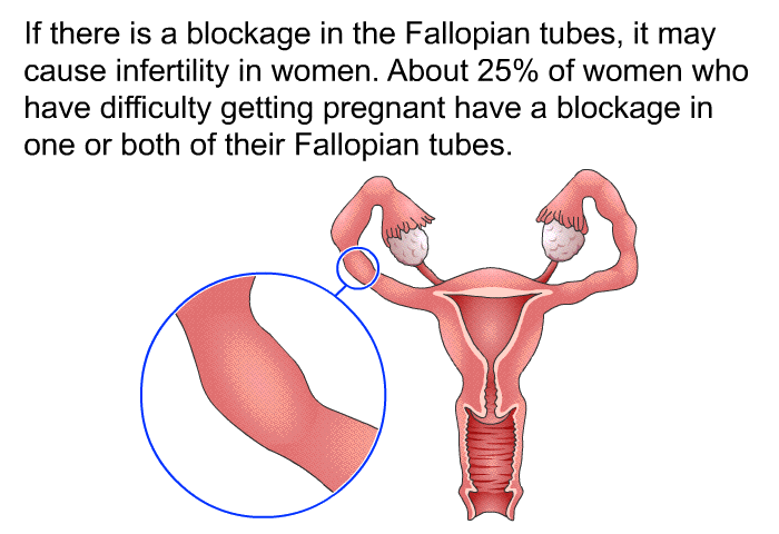 If there is a blockage in the Fallopian tubes, it may cause infertility in women. About 25% of women who have difficulty getting pregnant have a blockage in one or both of their Fallopian tubes.