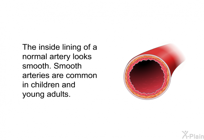 The inside lining of a normal artery looks smooth. Smooth arteries are common in children and young adults.