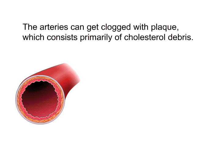 The arteries can get clogged with plaque, which consists primarily of cholesterol debris.