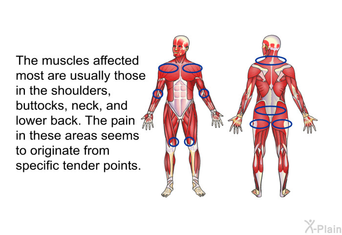 The muscles affected most are usually those in the shoulders, buttocks, neck, and lower back. The pain in these areas seems to originate from specific tender points.