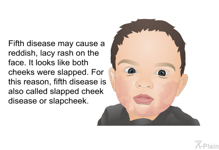 Fifth disease may cause a reddish, lacy rash on the face. It looks like both cheeks were slapped. For this reason, fifth disease is also called slapped cheek disease or slapcheek.