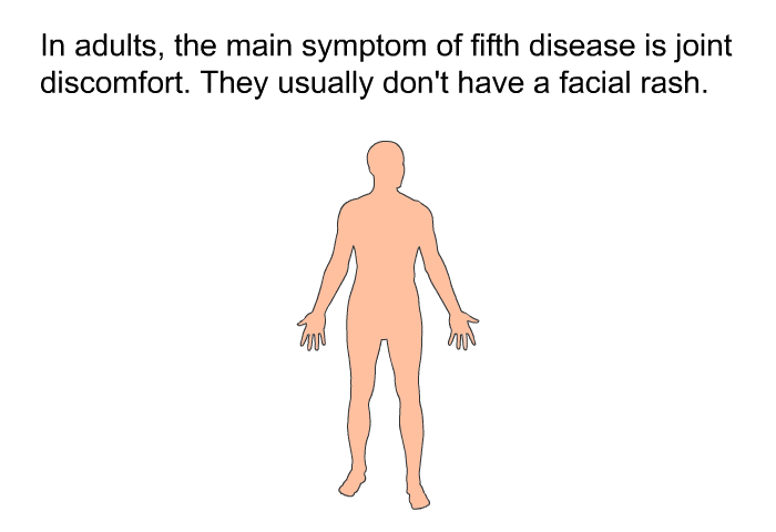 In adults, the main symptom of fifth disease is joint discomfort. They usually don't have a facial rash.