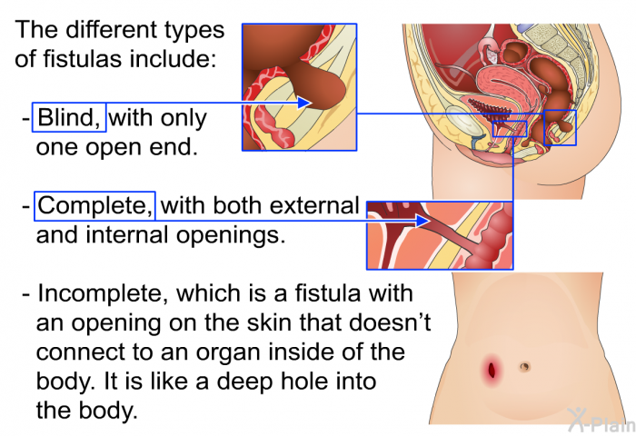 The different types of fistulas include:  Blind, with only one open end. Complete, with both external and internal openings. Incomplete, which is a fistula with an opening on the skin that doesn’t connect to an organ inside of the body. It is like a deep hole into the body.