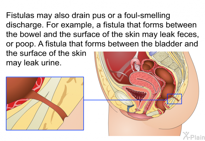 Fistulas may also drain pus or a foul-smelling discharge. For example, a fistula that forms between the bowel and the surface of the skin may leak feces, or poop. A fistula that forms between the bladder and the surface of the skin may leak urine.
