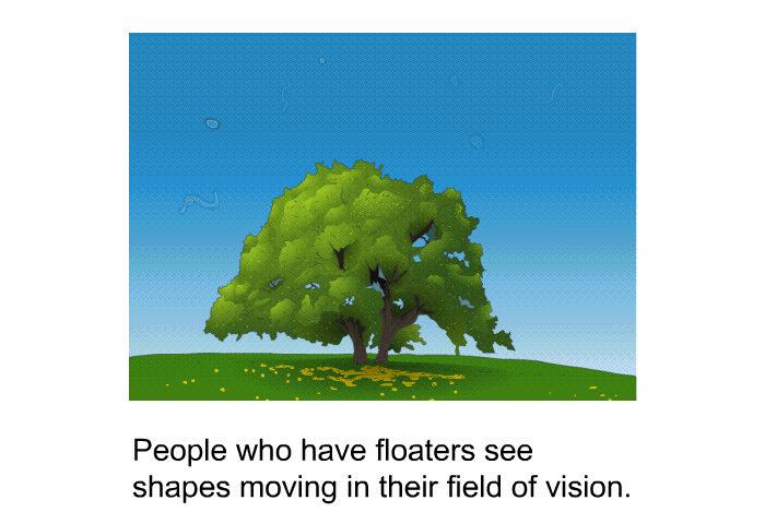 People who have floaters see shapes moving in their field of vision.