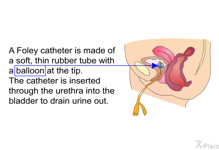 A Foley catheter is made of a soft, thin rubber tube with a balloon at the tip. The catheter is inserted through the urethra into the bladder to drain urine out.