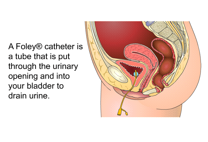 A Foley<SUP> </SUP> catheter is a tube that is put through the urinary opening and into your bladder to drain urine.