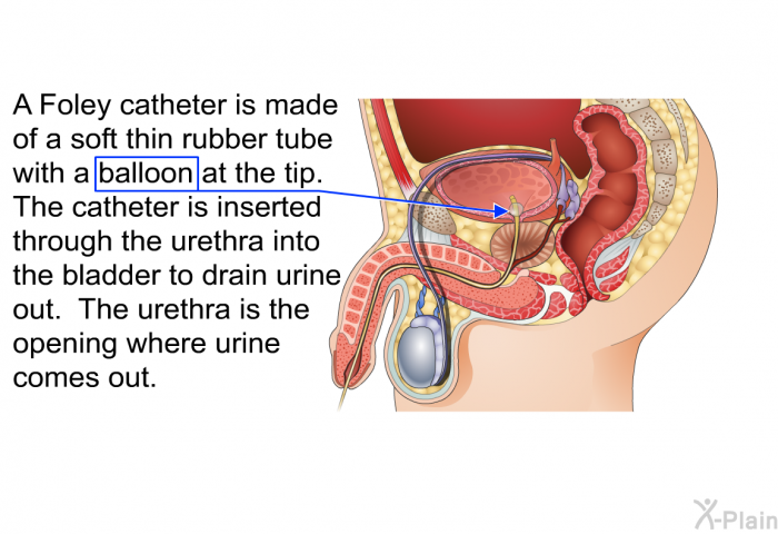 A Foley catheter is made of a soft thin rubber tube with a balloon at the tip. The catheter is inserted through the urethra into the bladder to drain urine out. The urethra is the opening where urine comes out.