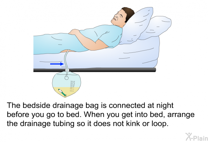 The bedside drainage bag is connected at night before you go to bed. When you get into bed, arrange the drainage tubing so it does not kink or loop.