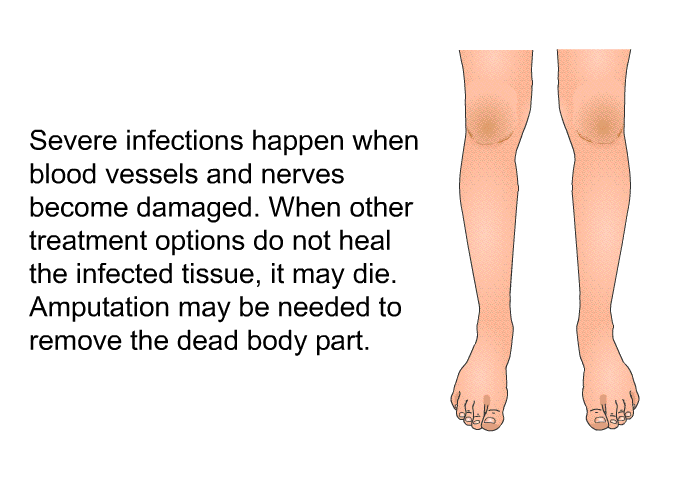Severe infections happen when blood vessels and nerves become damaged. When other treatment options do not heal the infected tissue, it may die. Amputation may be needed to remove the dead body part.