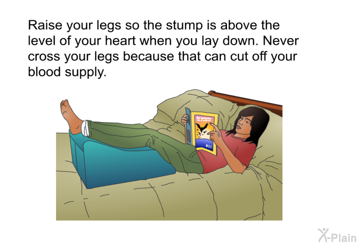 Raise your legs so the stump is above the level of your heart when you lay down. Never cross your legs because that can cut off your blood supply.
