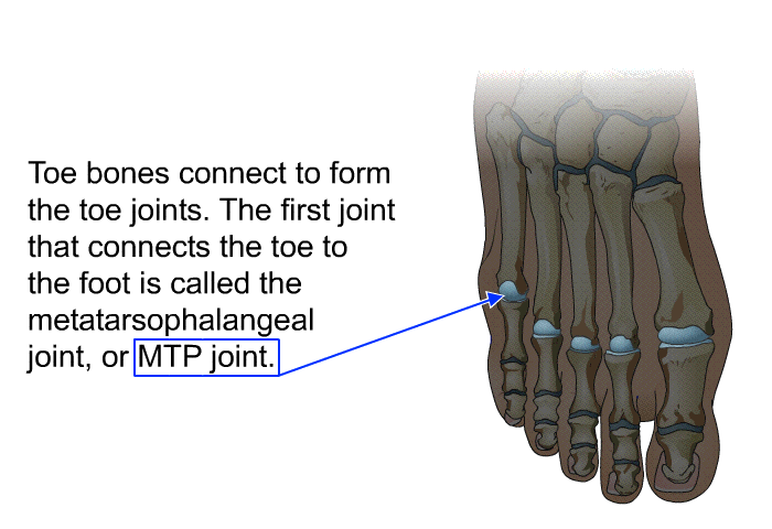 Toe bones connect to form the toe joints. The first joint that connects the toe to the foot is called the metatarsophalangeal joint, or MTP joint.