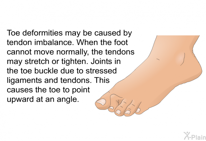 Toe deformities may be caused by tendon imbalance. When the foot cannot move normally, the tendons may stretch or tighten. Joints in the toe buckle due to stressed ligaments and tendons. This causes the toe to point upward at an angle.