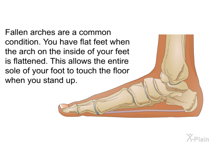 Fallen arches are a common condition. You have flat feet when the arch on the inside of your feet is flattened. This allows the entire sole of your foot to touch the floor when you stand up.
