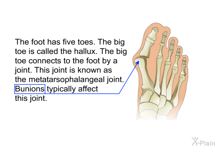 The foot has five toes. The big toe is called the hallux. The big toe connects to the foot by a joint. This joint is known as the metatarsophalangeal joint. Bunions typically affect this joint.