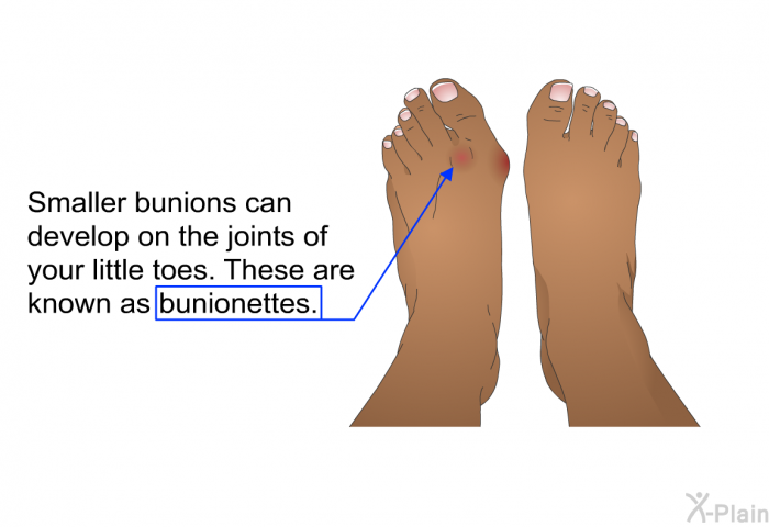 Smaller bunions can develop on the joints of your little toes. These are known as bunionettes.
