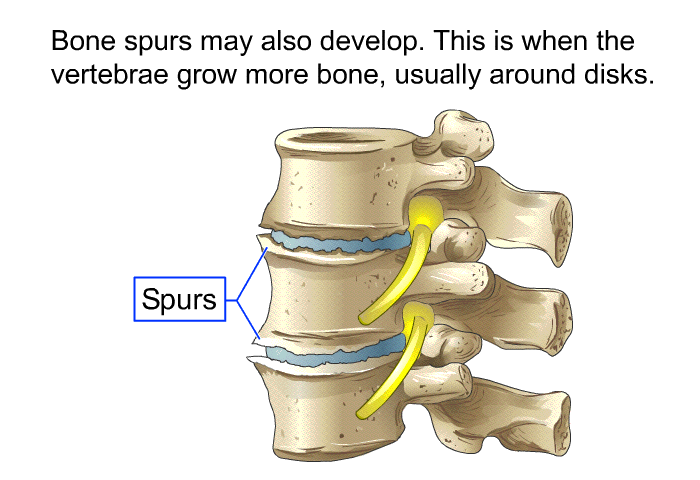 Bone spurs may also develop. This is when the vertebrae grow more bone, usually around disks.
