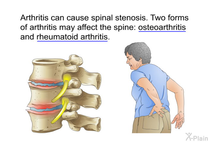 Arthritis can cause spinal stenosis. Two forms of arthritis may affect the spine: osteoarthritis and rheumatoid arthritis.