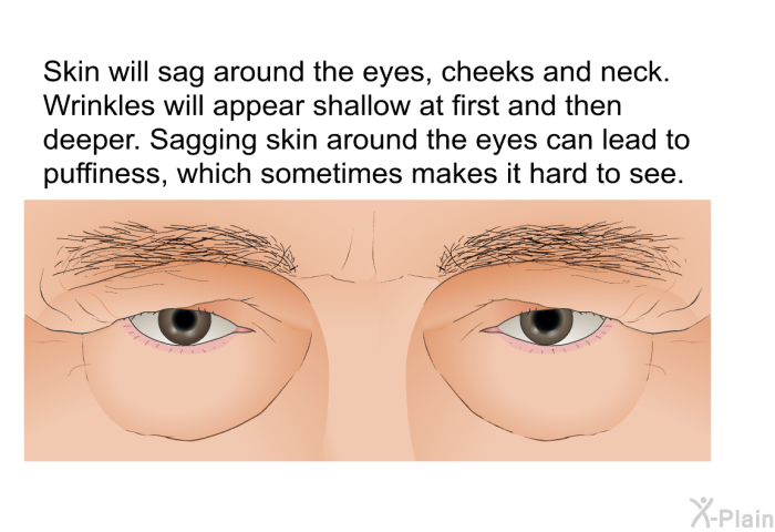 Skin will sag around the eyes, cheeks and neck. Wrinkles will appear shallow at first and then deeper. Sagging skin around the eyes can lead to puffiness, which sometimes makes it hard to see.