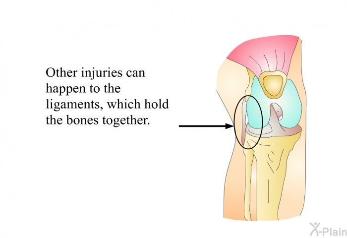 Other injuries can happen to the ligaments, which hold the bones together.