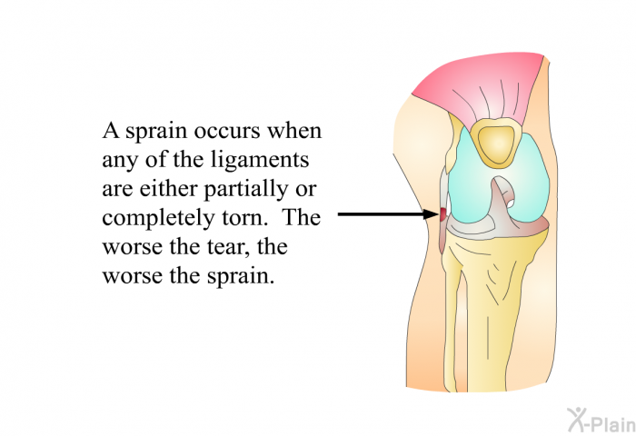 A sprain occurs when any of the ligaments are either partially or completely torn. The worse the tear, the worse the sprain.