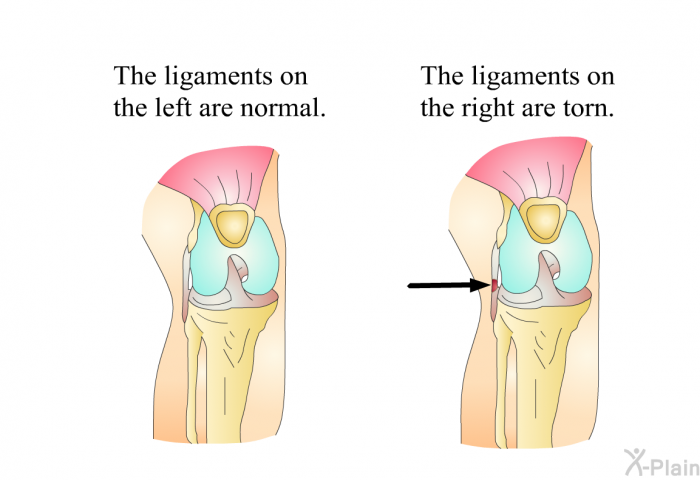 The ligaments on the left are normal. The ligaments on the right are torn.