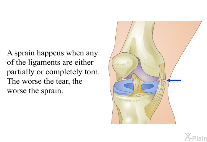 A sprain happens when any of the ligaments are either partially or completely torn. The worse the tear, the worse the sprain.